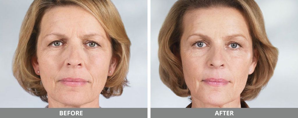 Sculptra Before & After