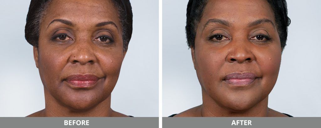 Sculptra Before & After