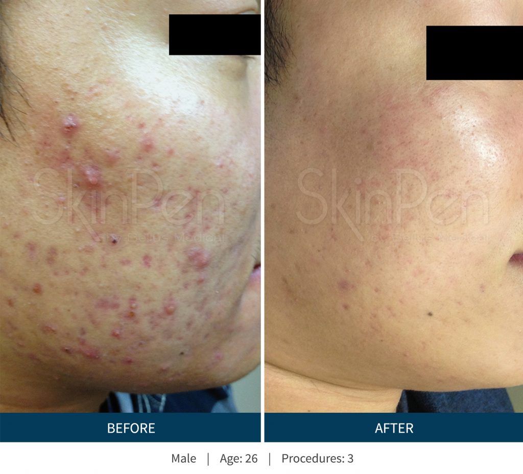 Microneedling Before & After
