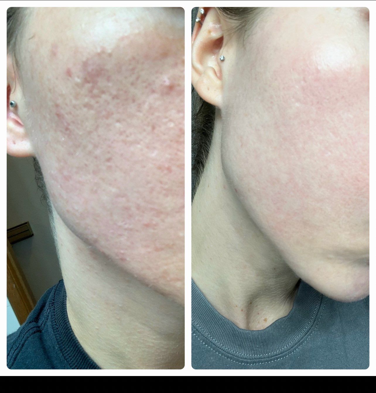 Microneedling Before & After