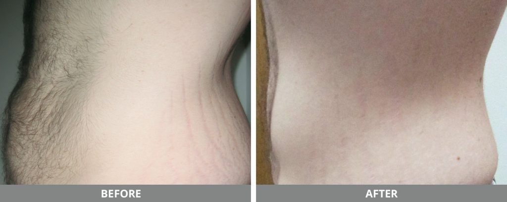 Viora Reaction Before & After