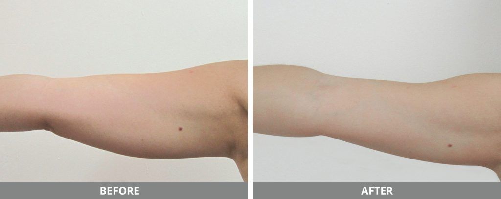 Viora Reaction Before & After