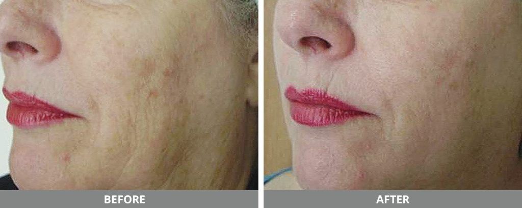 Viora Reaction Before & After