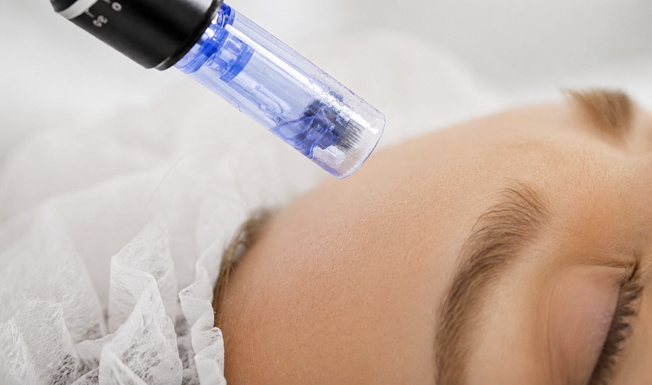 Microneedling procedure on a client's face.